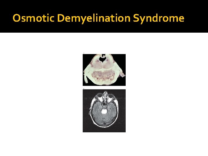 Osmotic Demyelination Syndrome 