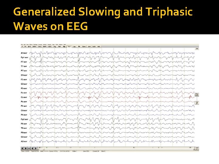 Generalized Slowing and Triphasic Waves on EEG 