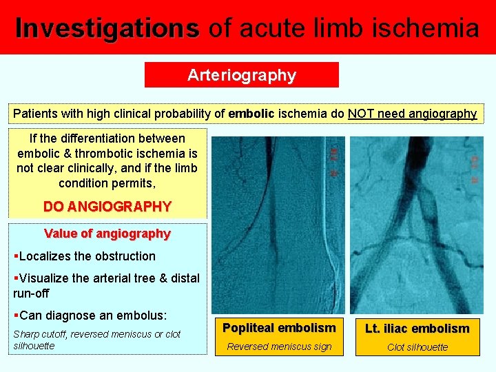 Investigations of acute limb ischemia Arteriography Patients with high clinical probability of embolic ischemia