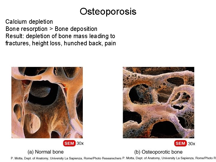 Osteoporosis Calcium depletion Bone resorption > Bone deposition Result: depletion of bone mass leading