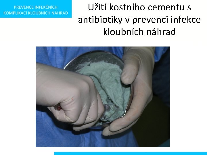 Užití kostního cementu s antibiotiky v prevenci infekce kloubních náhrad 