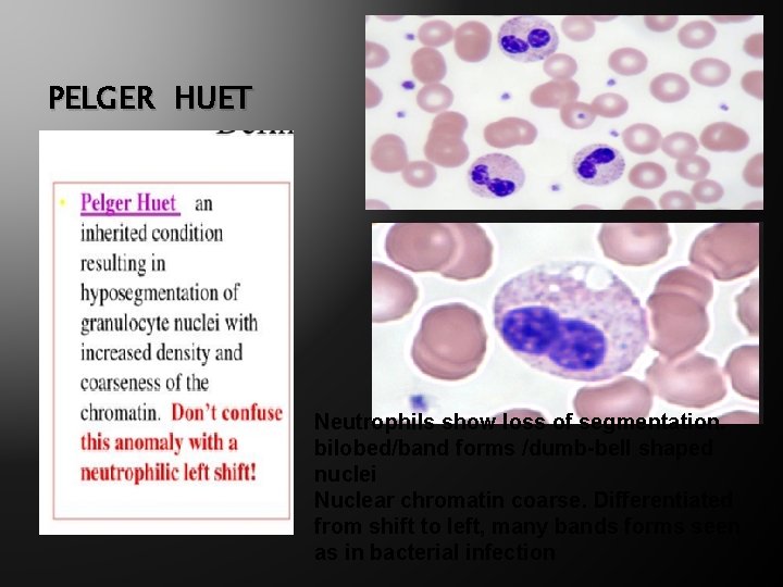 PELGER HUET Neutrophils show loss of segmentation. bilobed/band forms /dumb-bell shaped nuclei Nuclear chromatin