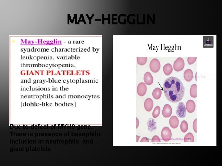 MAY-HEGGLIN Due to defect of MYH 9 gene. There is presence of basophilic inclusion