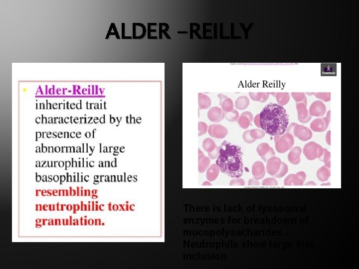 ALDER -REILLY There is lack of lysosomal enzymes for breakdown of mucopolysacharides. Neutrophils show