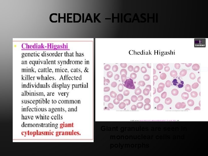 CHEDIAK -HIGASHI Giant granules are seen in mononuclear cells and polymorphs 