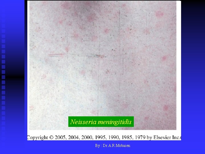 Neisseria meningitidis By : Dr. A. R. Mobaien 