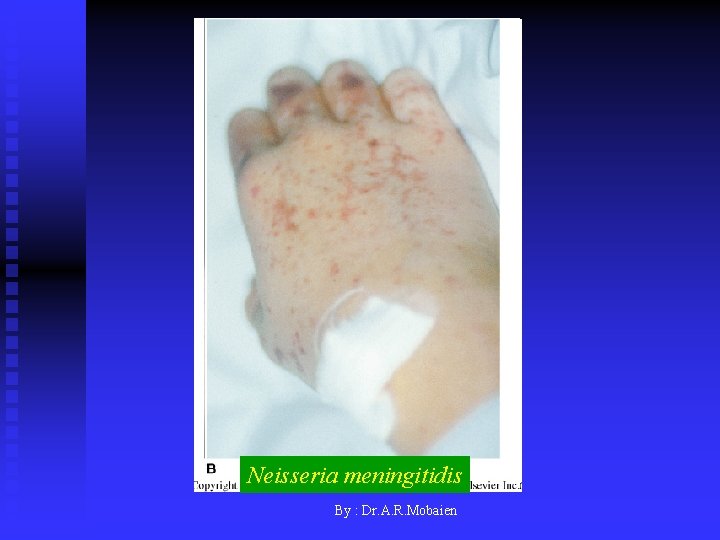 Neisseria meningitidis By : Dr. A. R. Mobaien 