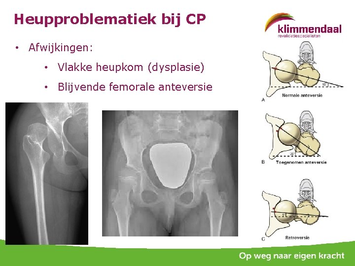 Heupproblematiek bij CP • Afwijkingen: • Vlakke heupkom (dysplasie) • Blijvende femorale anteversie 