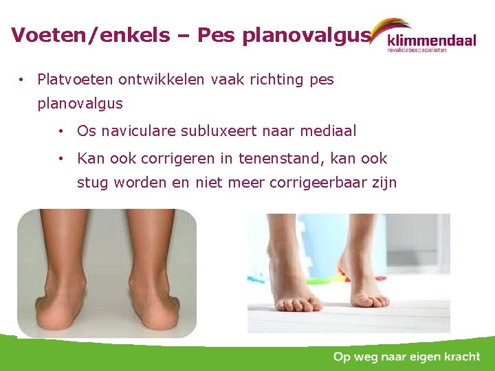 Voeten/enkels – Pes planovalgus • Platvoeten ontwikkelen vaak richting pes planovalgus • Os naviculare