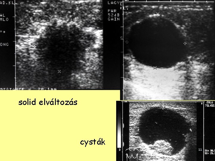 solid elváltozás cysták 11 