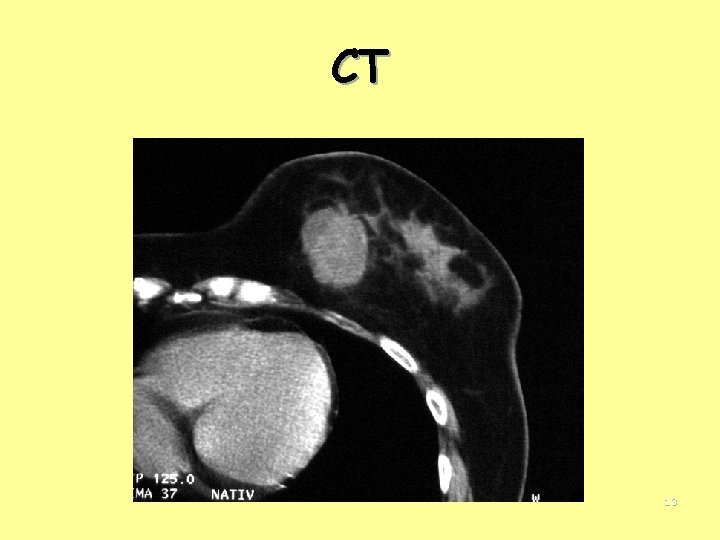 CT 13 