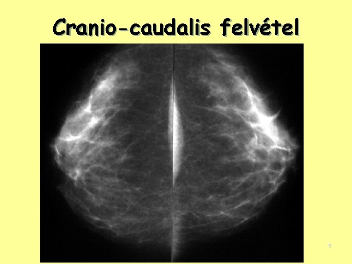 Cranio-caudalis felvétel 5 