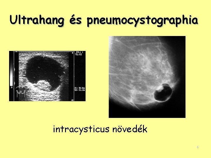 Ultrahang és pneumocystographia intracysticus növedék 6 