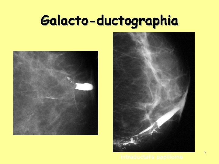 Galacto-ductographia intraductalis papilloma 7 