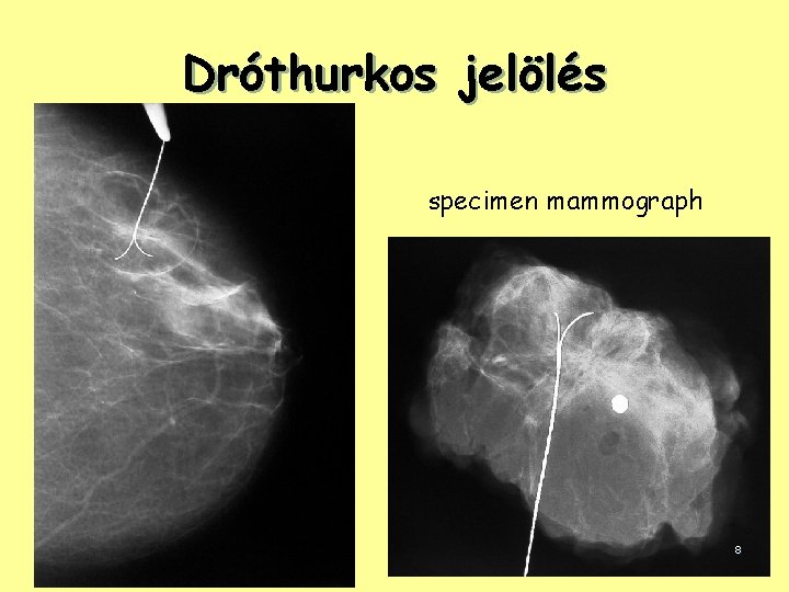 Dróthurkos jelölés specimen mammograph 8 