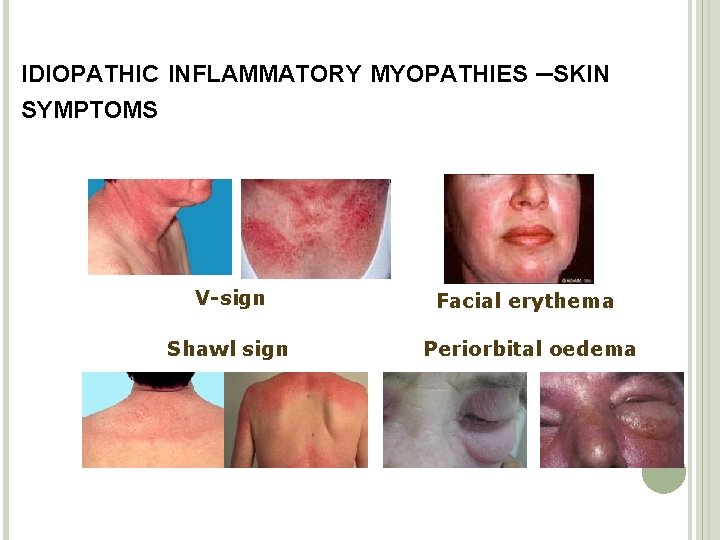 IDIOPATHIC INFLAMMATORY MYOPATHIES –SKIN SYMPTOMS V-sign Facial erythema Shawl sign Periorbital oedema 