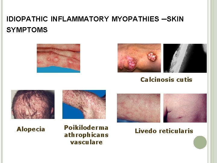 IDIOPATHIC INFLAMMATORY MYOPATHIES –SKIN SYMPTOMS Calcinosis cutis Alopecia Poikiloderma athrophicans vasculare Livedo reticularis 