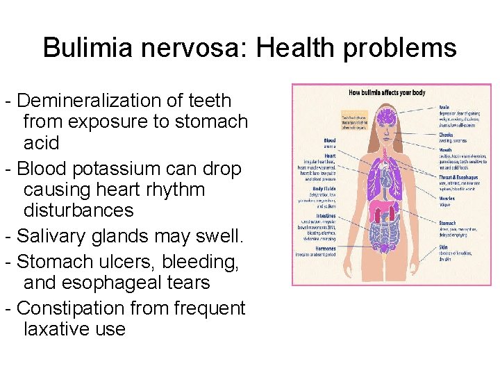 Bulimia nervosa: Health problems - Demineralization of teeth from exposure to stomach acid -