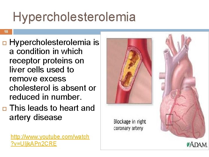 Hypercholesterolemia 18 Hypercholesterolemia is a condition in which receptor proteins on liver cells used
