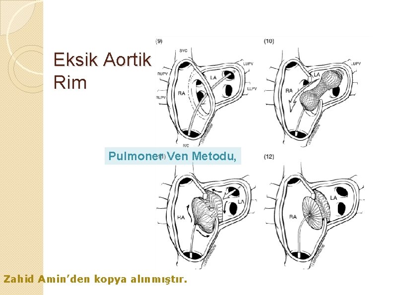 Eksik Aortik Rim Pulmoner Ven Metodu, Zahid Amin’den kopya alınmıştır. 