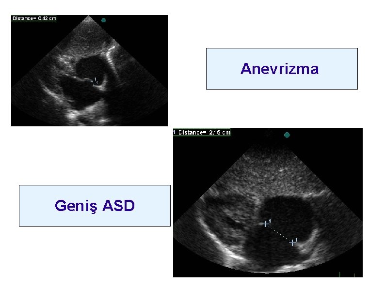 Anevrizma Geniş ASD 