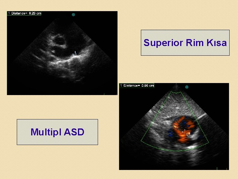 Superior Rim Kısa Multipl ASD 