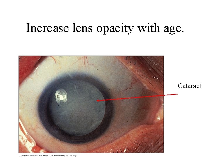 Increase lens opacity with age. Cataract 