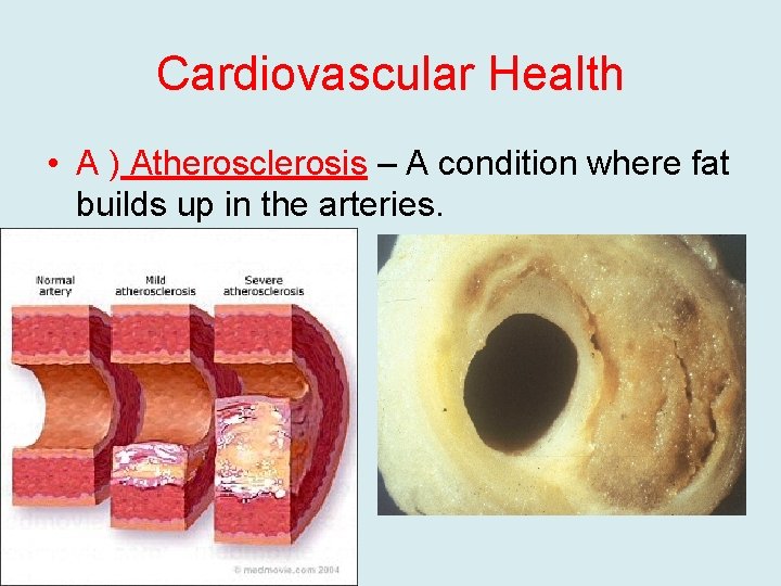 Cardiovascular Health • A ) Atherosclerosis – A condition where fat builds up in