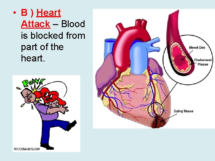  • B ) Heart Attack – Blood is blocked from part of the
