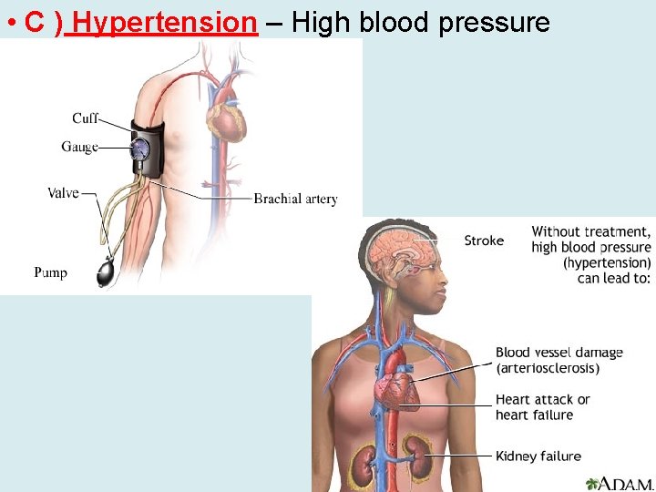  • C ) Hypertension – High blood pressure 