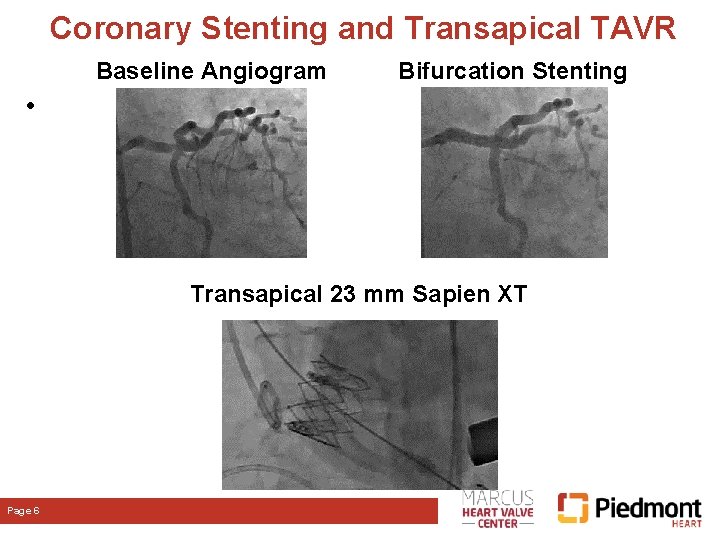 Coronary Stenting and Transapical TAVR Baseline Angiogram Bifurcation Stenting • Transapical 23 mm Sapien Coronary Stenting and Transapical TAVR Baseline Angiogram Bifurcation Stenting • Transapical 23 mm Sapien