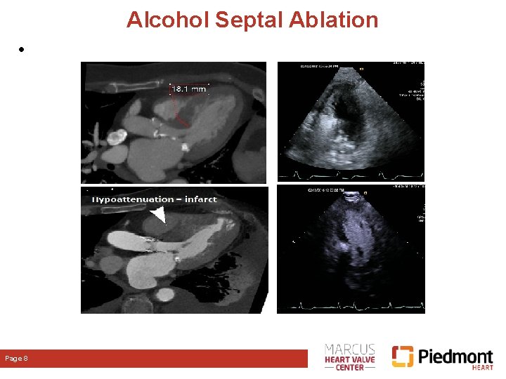 Alcohol Septal Ablation • Page 8 Alcohol Septal Ablation • Page 8