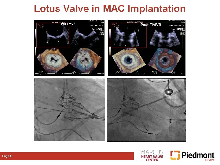 Lotus Valve in MAC Implantation Page 9 Lotus Valve in MAC Implantation Page 9