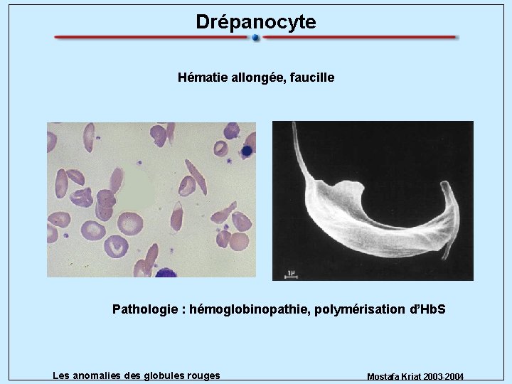 Drépanocyte Hématie allongée, faucille Pathologie : hémoglobinopathie, polymérisation d’Hb. S Les anomalies des globules