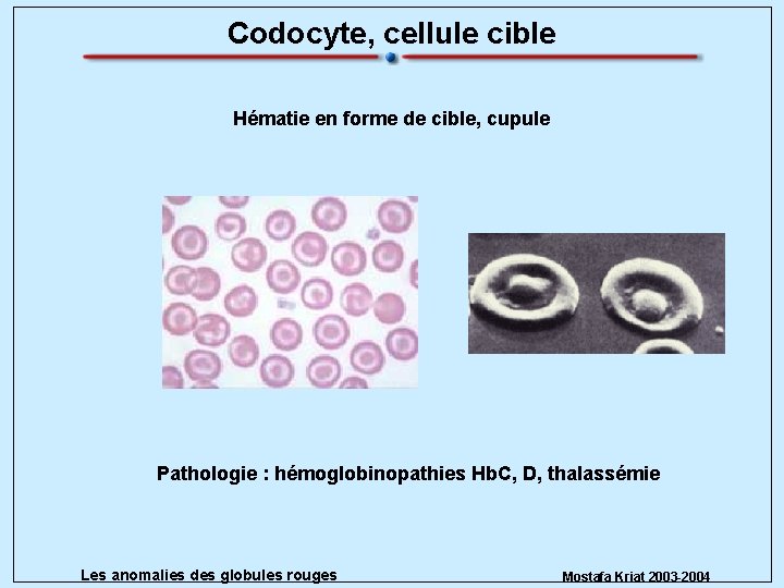Codocyte, cellule cible Hématie en forme de cible, cupule Pathologie : hémoglobinopathies Hb. C,
