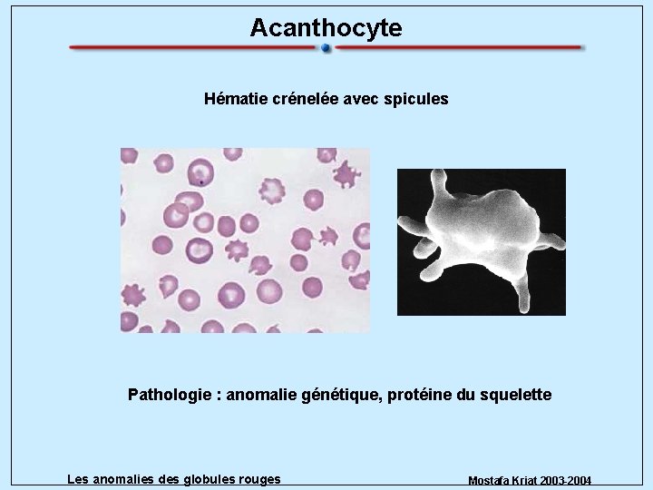 Acanthocyte Hématie crénelée avec spicules Pathologie : anomalie génétique, protéine du squelette Les anomalies