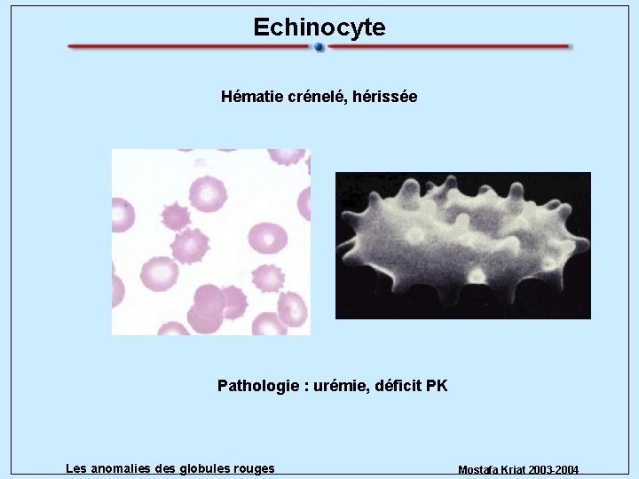 Echinocyte Hématie crénelé, hérissée Pathologie : urémie, déficit PK Les anomalies des globules rouges
