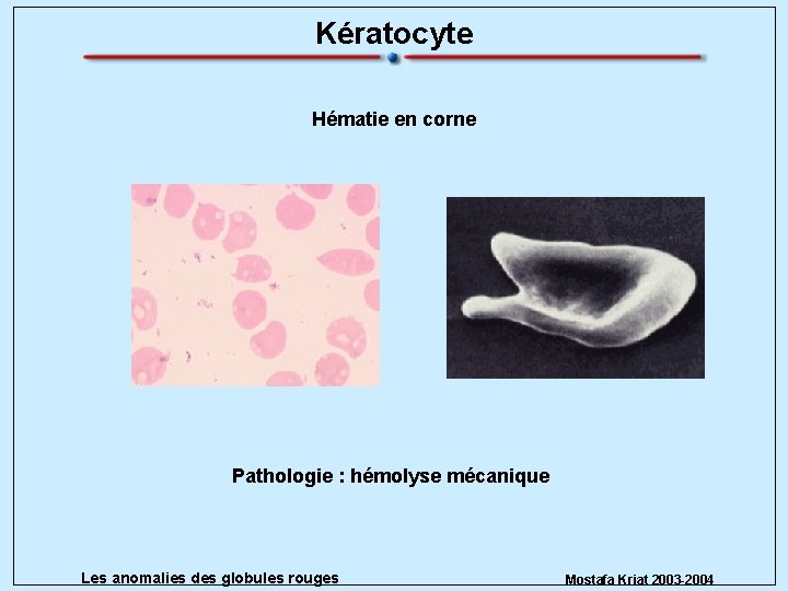 Kératocyte Hématie en corne Pathologie : hémolyse mécanique Les anomalies des globules rouges Mostafa