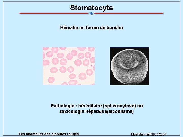 Stomatocyte Hématie en forme de bouche Pathologie : héréditaire (sphérocytose) ou toxicologie hépatique(alcoolisme) Les