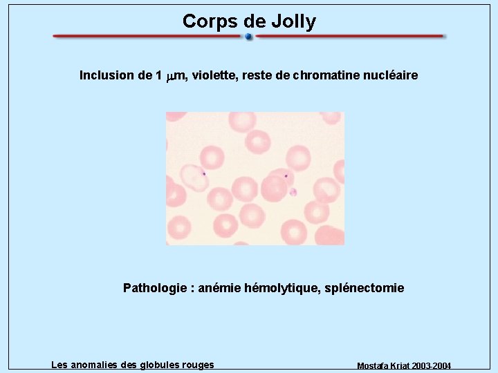 Corps de Jolly Inclusion de 1 mm, violette, reste de chromatine nucléaire Pathologie :