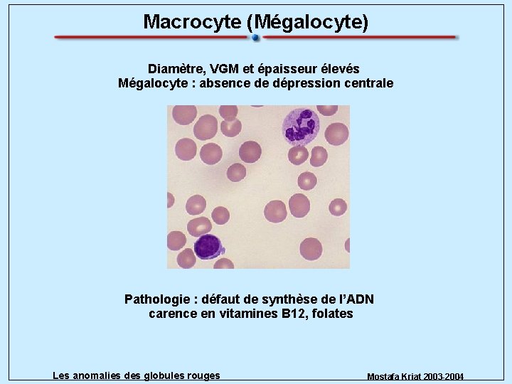Macrocyte (Mégalocyte) Diamètre, VGM et épaisseur élevés Mégalocyte : absence de dépression centrale Pathologie