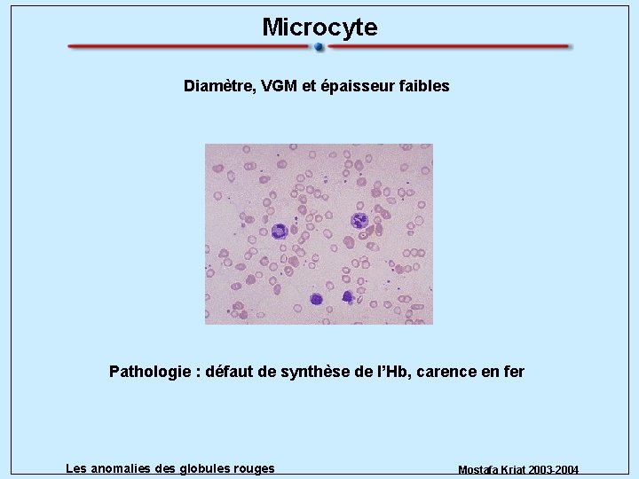 Microcyte Diamètre, VGM et épaisseur faibles Pathologie : défaut de synthèse de l’Hb, carence