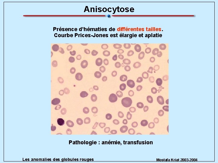 Anisocytose Présence d’hématies de différentes tailles. Courbe Prices-Jones est élargie et aplatie Pathologie :