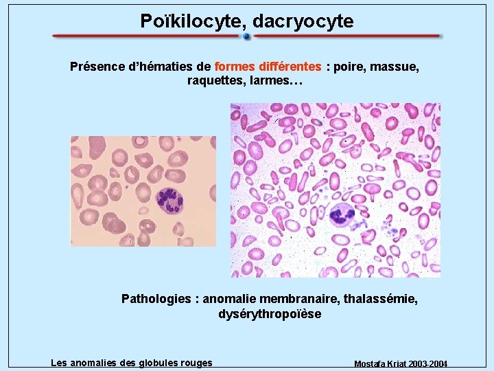 Poïkilocyte, dacryocyte Présence d’hématies de formes différentes : poire, massue, raquettes, larmes… Pathologies :