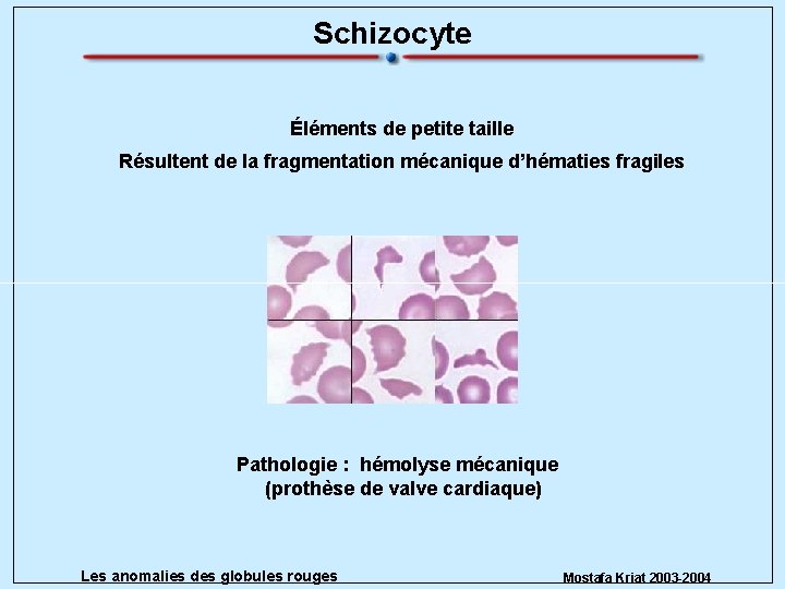 Schizocyte Éléments de petite taille Résultent de la fragmentation mécanique d’hématies fragiles Pathologie :