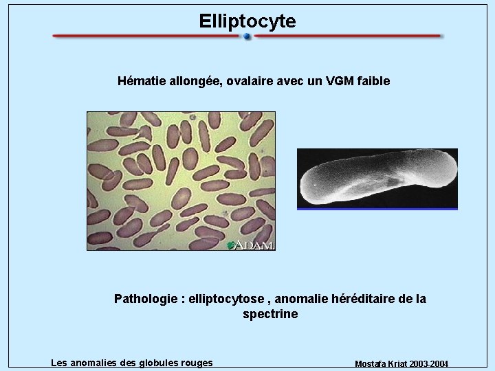 Elliptocyte Hématie allongée, ovalaire avec un VGM faible Pathologie : elliptocytose , anomalie héréditaire