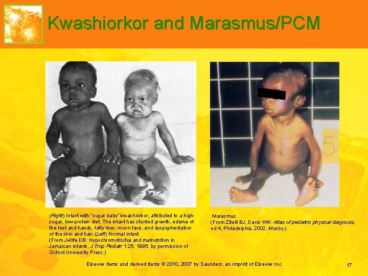 Kwashiorkor and Marasmus/PCM (Right) Infant with “sugar baby” kwashiorkor, attributed to a highsugar, low-protein