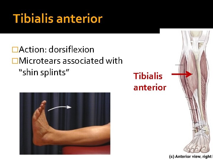 Tibialis anterior �Action: dorsiflexion �Microtears associated with “shin splints” Tibialis anterior 