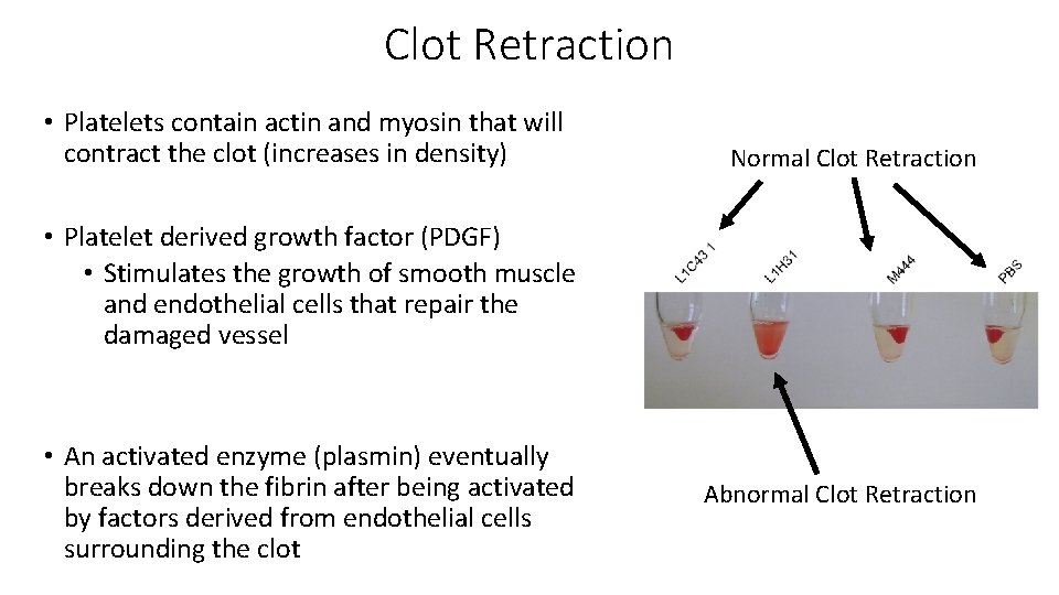 Clot Retraction • Platelets contain actin and myosin that will contract the clot (increases