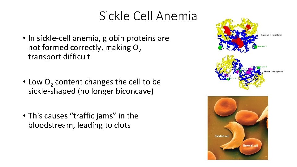 Sickle Cell Anemia • In sickle-cell anemia, globin proteins are not formed correctly, making